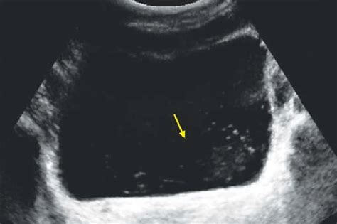 Urinary Bladder Ultrasound