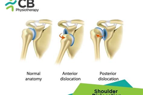 What is Shoulder Dislocation? Symptoms, Causes, Diagnosis & Physiotherapy Treatment of Shoulder ...