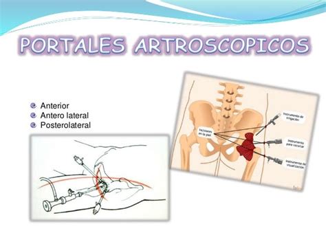 Artroscopia de cadera