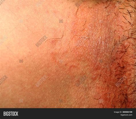 Fungal Infection Groin Image & Photo (Free Trial) | Bigstock