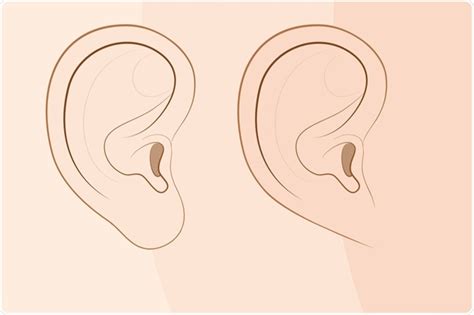 Genetics Of Earlobes | informacionpublica.svet.gob.gt