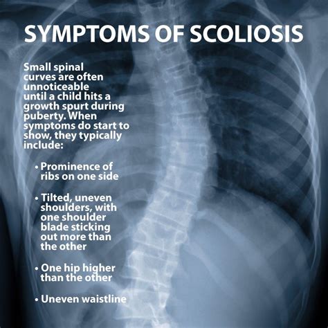 Scoliosis Information | Florida Orthopaedic Institute