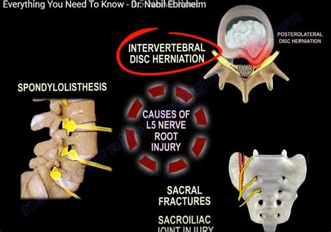 L5 Nerve Root: Clinical Exam and Pathologies — OrthopaedicPrinciples.com