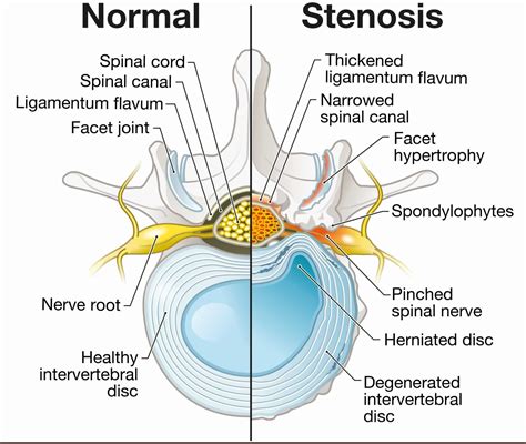 Central Canal Stenosis: Definition - Spine Info