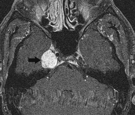 Cavernous Sinus Thrombosis Mri