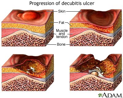 How to care for pressure sores Information | Mount Sinai - New York