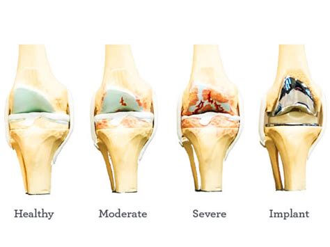 Knee Replacement Pain Guide