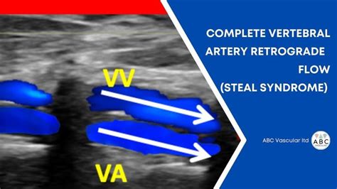 Subclavian Artery, Vertebral Artery, Video Case, Retrograde, Arteries, Ultrasound, Syndrome ...