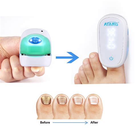 Fungal Nail Treatment Laser Device For Nail Fungus 905nm 470nm Fungus Nail Removal Anti ...