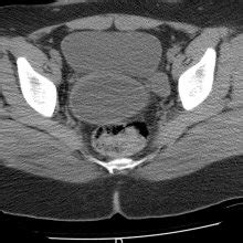 CT scan axial cuts shows hematocolpos. | Download Scientific Diagram