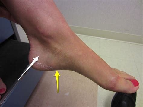 Calcaneus Stress Fractures | Dr. David Geier - Sports Medicine Simplified