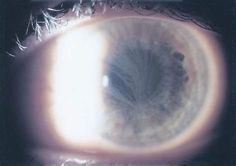 Fabry disease - American Academy of Ophthalmology