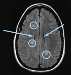 MRI Brain White Spots Cause | Mri Scan Images | Multiple Sclerosis ...