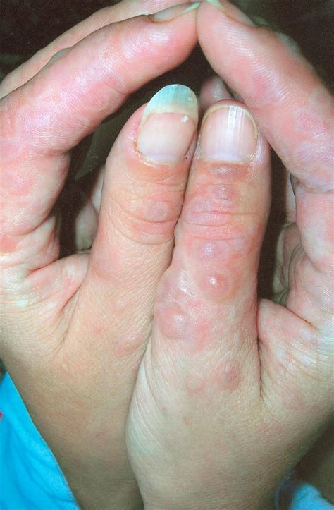 Erythema multiforme - Dermatology Advisor