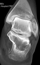 Calcaneal Fracture - Musculoskeletal Case Studies - CTisus CT Scanning