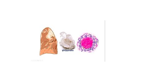 SILICOSIS - Pathology Made Simple