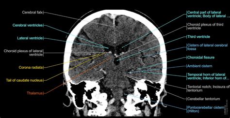 Normal Brain Ct Anatomy