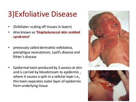 SSSS / Lyells disease / Ritters disease... Epidermis, Dermatology, Cellular, Syndrome, Disease ...