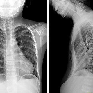 Chest X-ray examination after the first operation. | Download ...