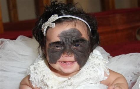 Baby with a ‘batman birthmark’ on face undergoes surgery | Parent24