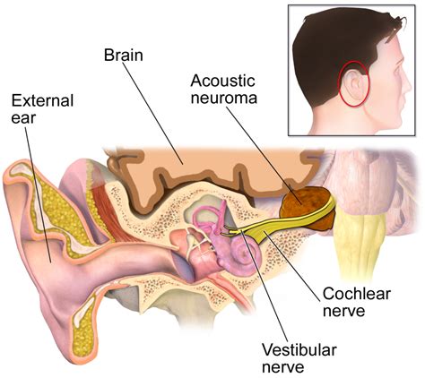 Acoustic Neuroma - Otolaryngology–Head & Neck Surgery