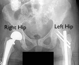 Medical Treatment Pictures-for Better Understanding: Partial Hip Replacement Surgery: Before ...