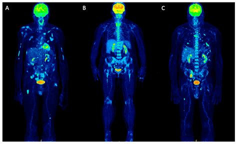 a positron emission tomography pet scan depicts brain activity by ...