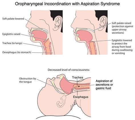 Pediatric Aspiration Syndromes - Pediatric Pulmonologists