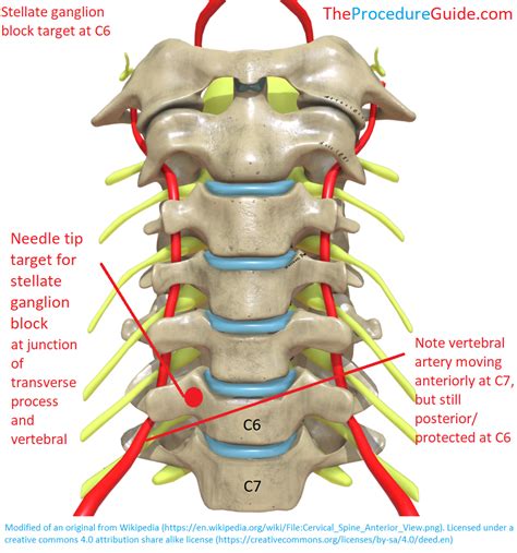 Fluoroscopic Guided Stellate Ganglion Block - Technique and Overview ...