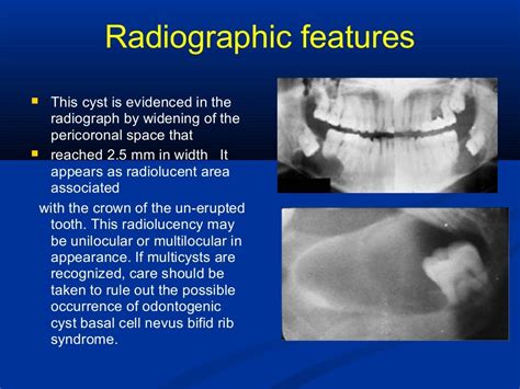 Odontogenic Cysts