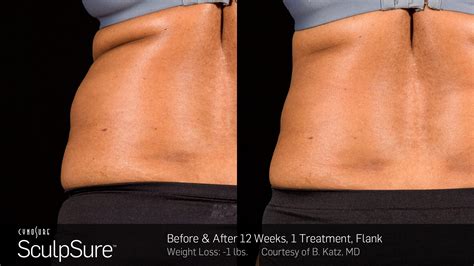 SculpSure Frequently Asked Questions (FAQs) - Dr. Joy Liu