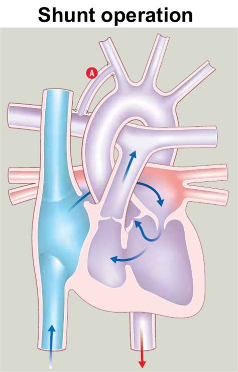 Tricuspid atresia causes, symptoms, diagnosis, treatment & prognosis