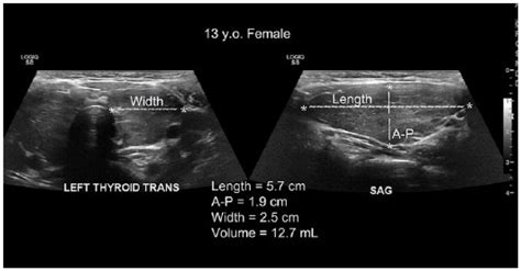 Sonographic Evaluation of Thyroid Size: A Review of Important Measurement Parameters - Alexander ...