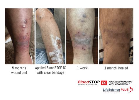 Case Study: BloodSTOP® iX Heals 5-month-old Chronic Ulcer Wound - LifeScience Plus | BloodSTOP