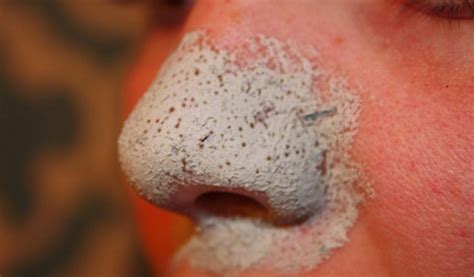 10 Top Home Remedies To Get Rid of Blackheads