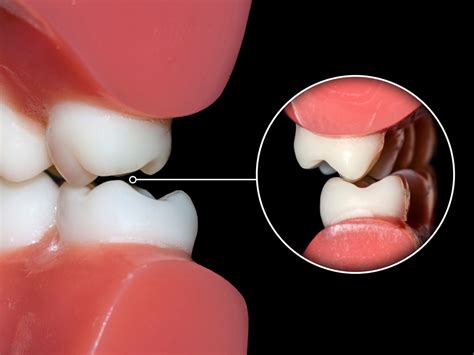 What is Dental Occlusion?