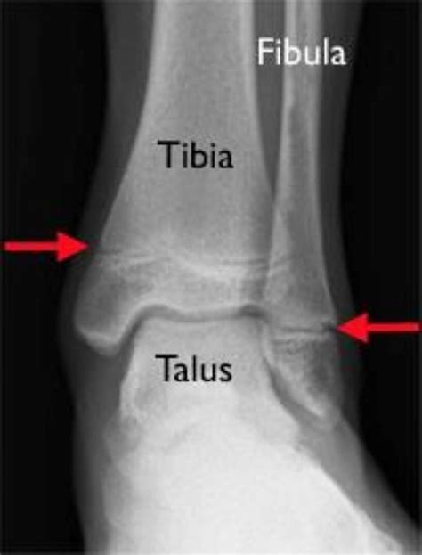 Triplane fracture causes, symptoms, diagnosis & treatment