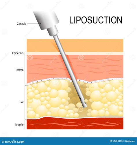 Liposuction. Cannula into the Fat Layer Beneath Skin. Stock Vector ...