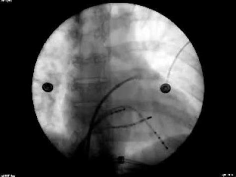 transseptal puncture HD - YouTube