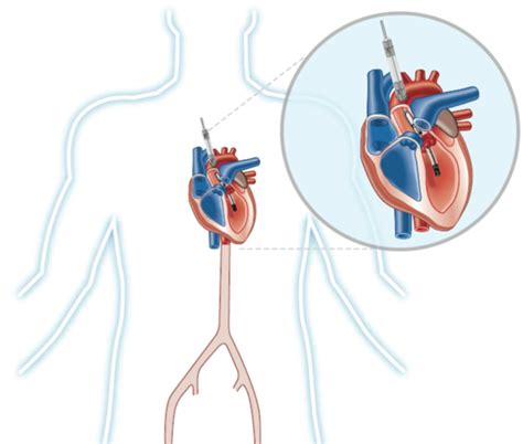 FDA likely to approve expanded indication of Abiomed's Impella heart ...