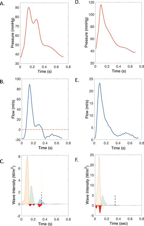 A unified mechanism for the water hammer pulse and pulsus bisferiens in severe aortic ...