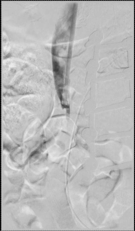 -Postfilter removal DSA demonstrates occlusion of the infra renal IVC... | Download Scientific ...