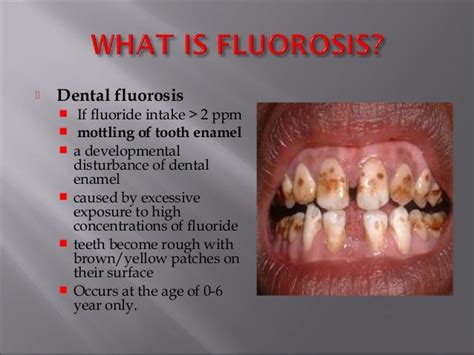 Dental fluorosis in india