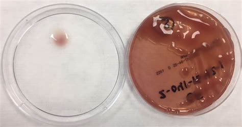 Microbiology Case Study: A 14 Year Old Cystic Fibrosis Patient ...