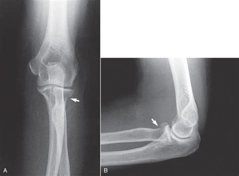 Elbow Fractures | Anesthesia Key