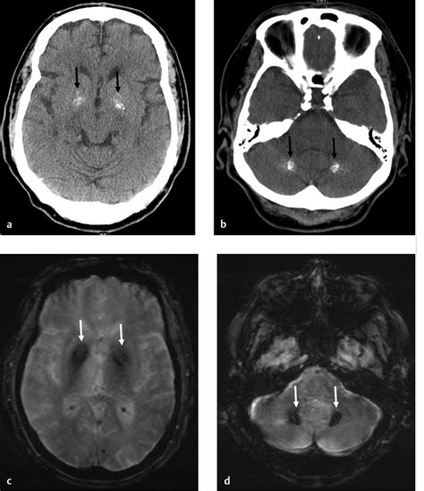 4 Basal Ganglia/Dentate Nuclei Mineralization | Radiology Key