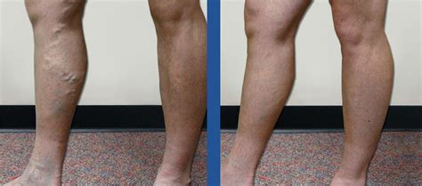 Vein Specialists of the Carolinas - Charlotte and Gastonia locations