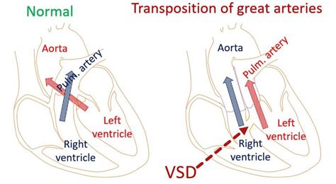 TGA like physiology – All About Cardiovascular System and Disorders