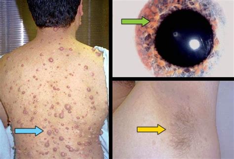 Phakomatoses (Neurocutaneous Syndromes): Multiple Systems Involved