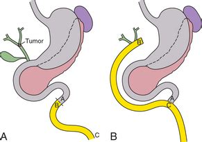 Teaching Visual: The Roux-en-Y Limb | Basicmedical Key